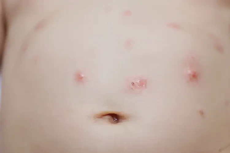 嬰兒肚子經(jīng)常起濕疹可不可以徹底自愈(圖4)