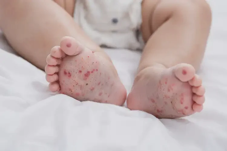 嬰兒小腿經(jīng)常起濕疹能靠自己自愈嗎(圖4)