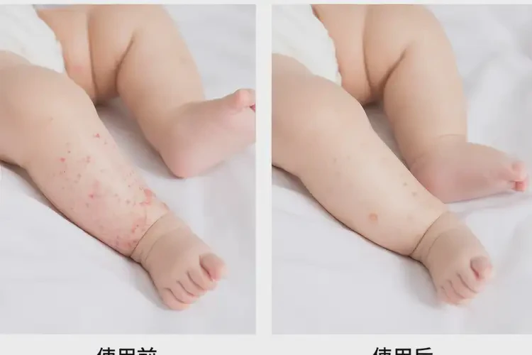 寶寶四肢起濕疹能夠徹底治愈嗎(圖2)