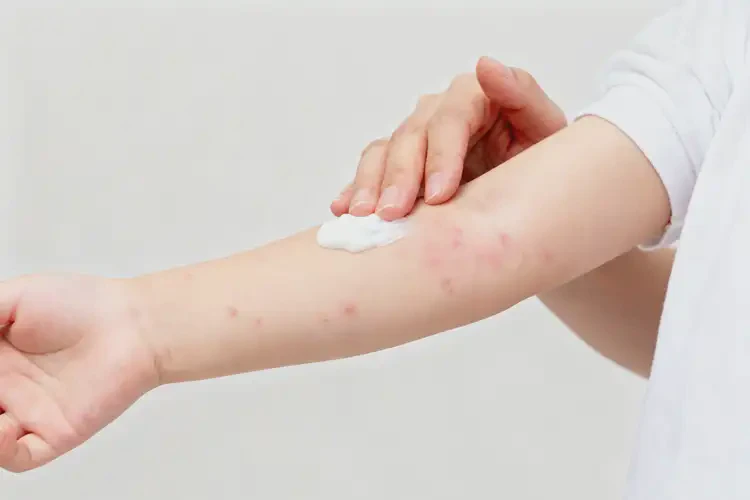 小孩手臂偶尔起湿疹能够彻底治愈吗(图2)