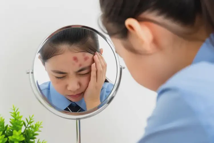 中學生臉上容易長濕疹不管它會自己好嗎(圖3)