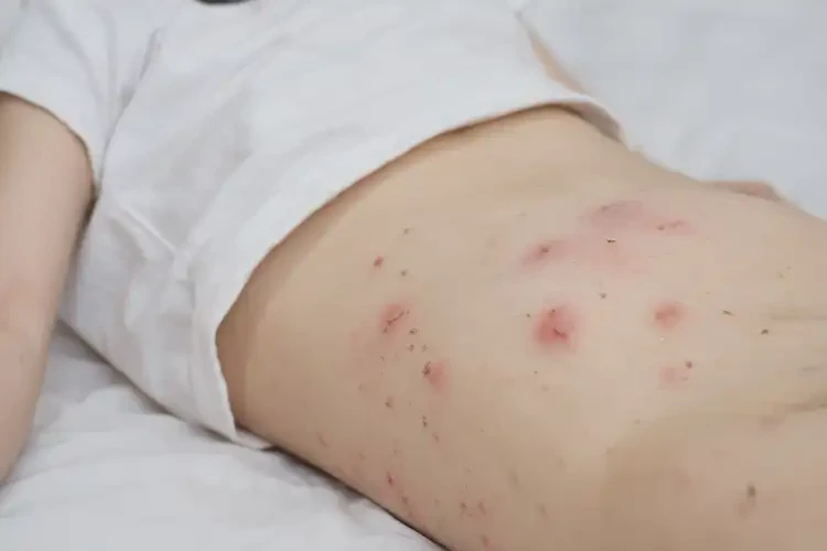 兒童肚子上偶爾長濕疹不管它會自己自愈嗎(圖4)