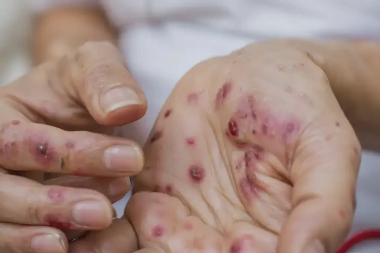 产妇手上长湿疹能彻底自愈吗(图4)