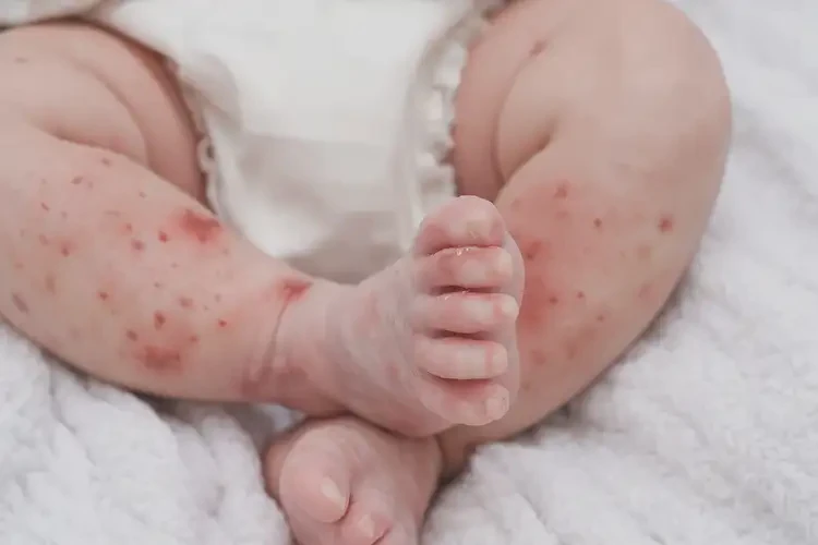 新生兒小腿有濕疹不管它會自己痊愈嗎(圖4)