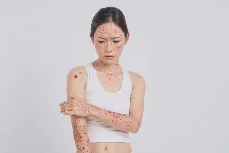 女生全身出濕疹不管它會自己好嗎(圖4)