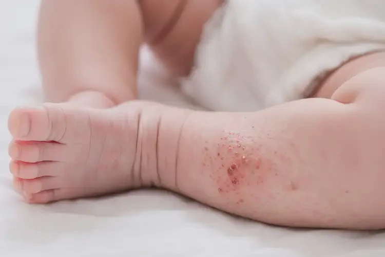 新生兒小腿長濕疹不管它會(huì)自己痊愈嗎(圖4)