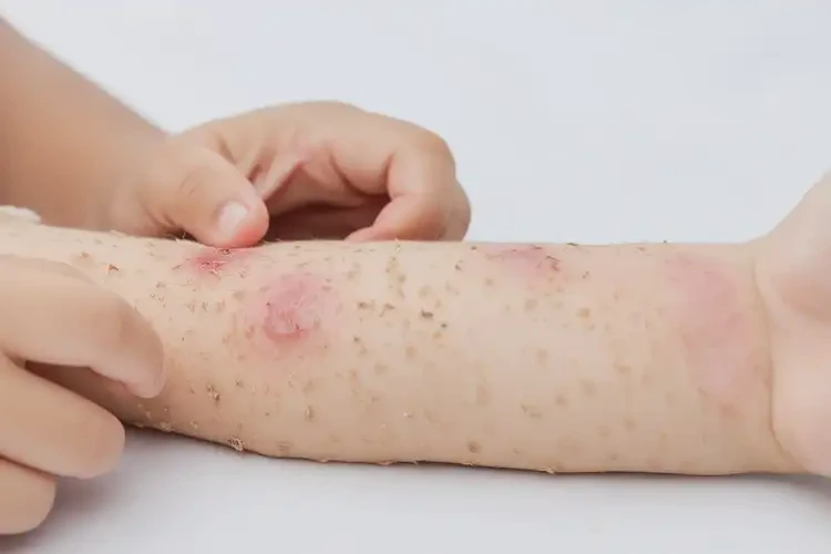 少兒手臂容易起濕疹不管它會(huì)自己好嗎(圖1)