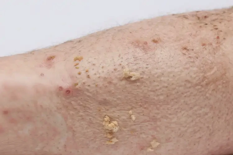 小學(xué)生小腿出現(xiàn)濕疹可不可以徹底自愈(圖2)