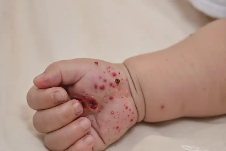 嬰兒手上出濕疹不管它會(huì)自己痊愈嗎(圖3)