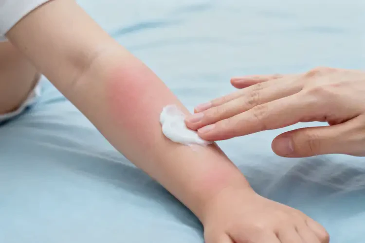 兒童手臂經(jīng)常起濕疹不管它會自己自愈嗎(圖3)