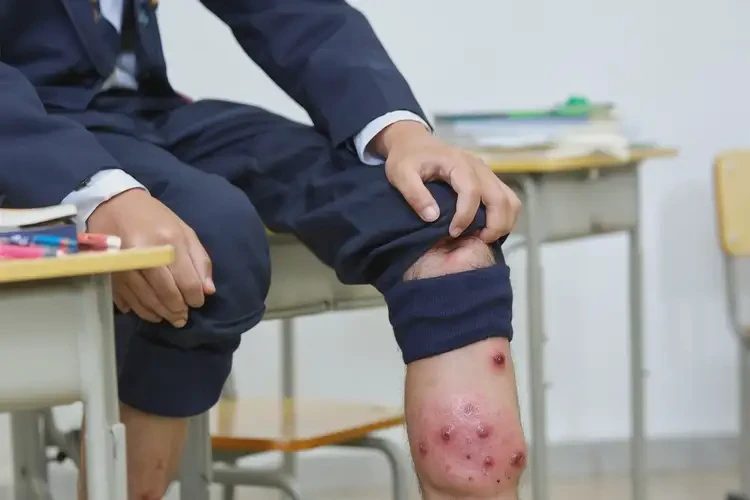 中學(xué)生小腿有濕疹不管它會(huì)自己自愈嗎(圖3)