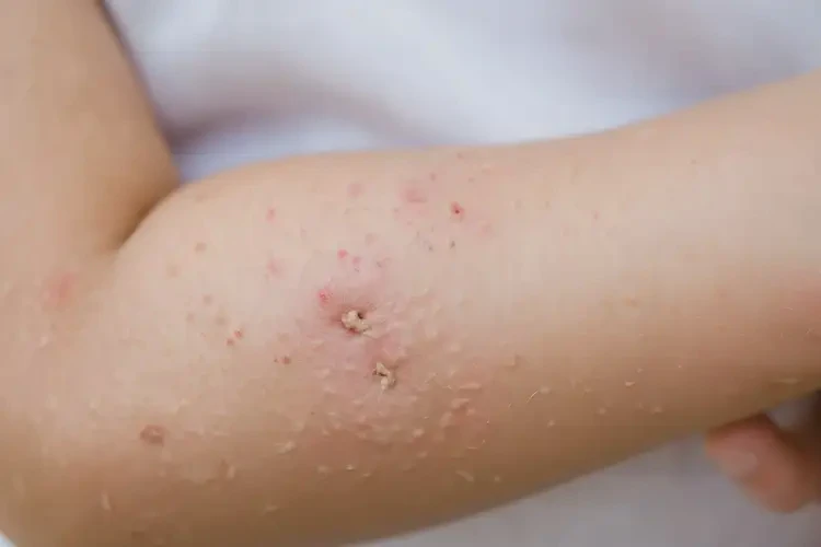 小孩手臂上經(jīng)常長(zhǎng)濕疹能靠自己自愈嗎(圖4)