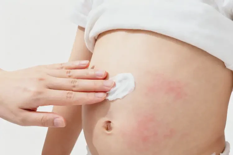 孩子肚子上有濕疹不管它會自己好嗎(圖1)