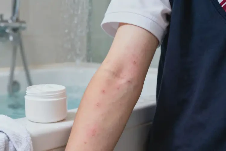 大學生四肢起濕疹不管它會自己好嗎(圖4)