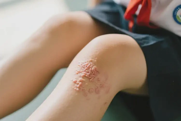 小學(xué)生小腿上長(zhǎng)濕疹不管它會(huì)自己自愈嗎(圖1)