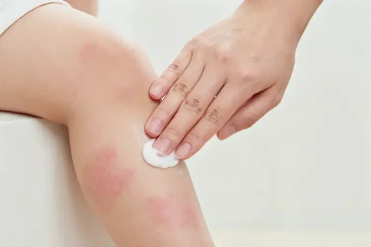 嬰兒小腿上起濕疹可不可以徹底自愈(圖2)