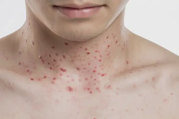 青年人脖子上經(jīng)常起濕疹能徹底自愈嗎(圖4)