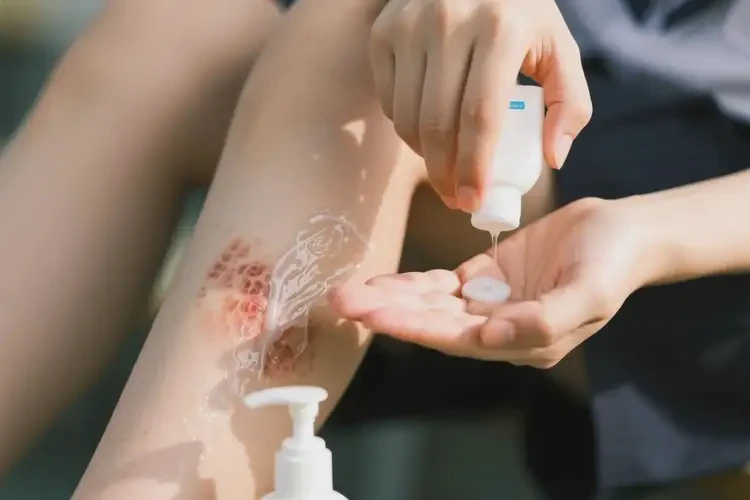 大學(xué)生小腿長濕疹可以徹底自愈嗎(圖3)