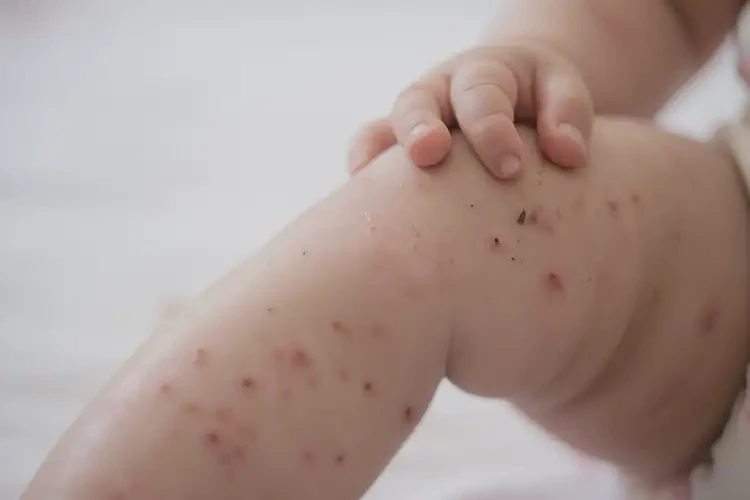 寶寶小腿容易長濕疹能夠徹底治愈嗎(圖4)