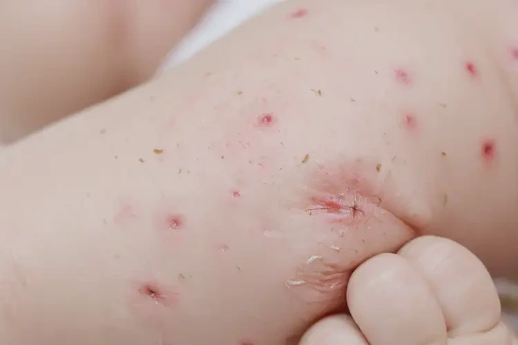 寶寶全身經(jīng)常起濕疹能夠徹底治愈嗎(圖4)