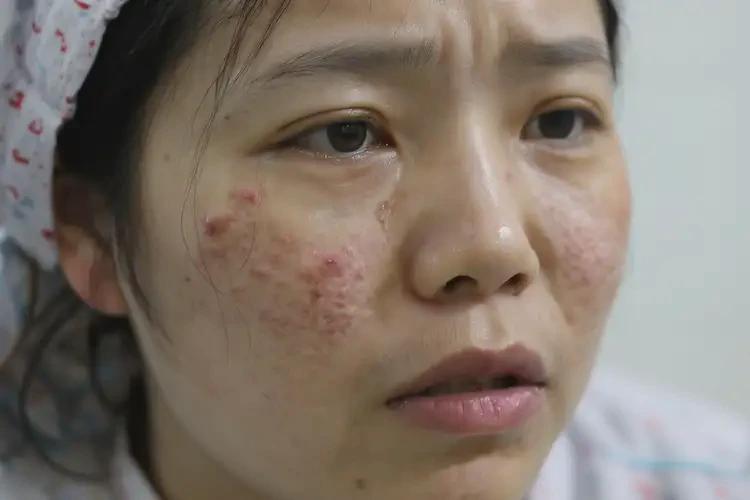 產(chǎn)婦面部起濕疹能靠自己自愈嗎(圖4)