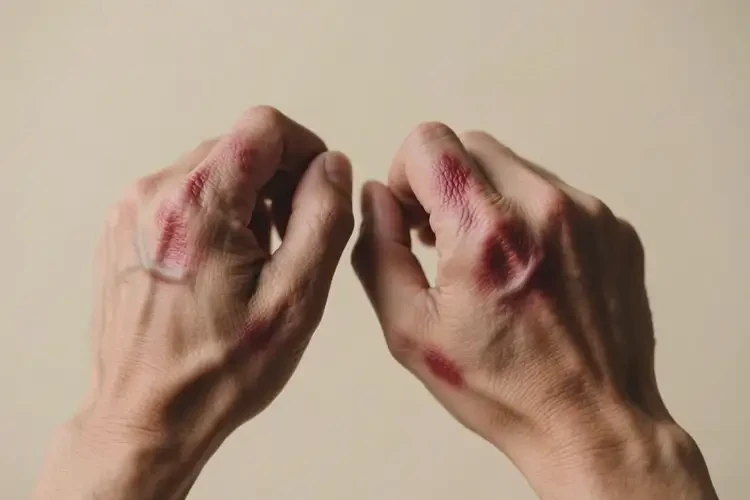 男性手上經(jīng)常長濕疹不管它會(huì)自己痊愈嗎(圖2)