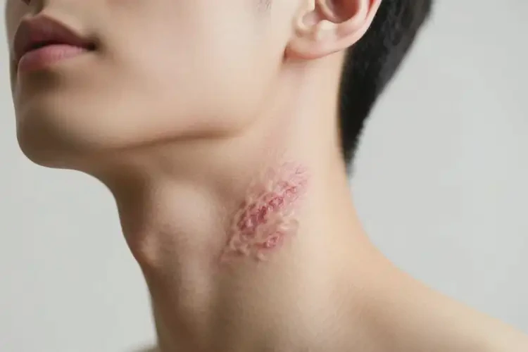 青年人脖子上出現(xiàn)濕疹可以徹底自愈嗎(圖1)