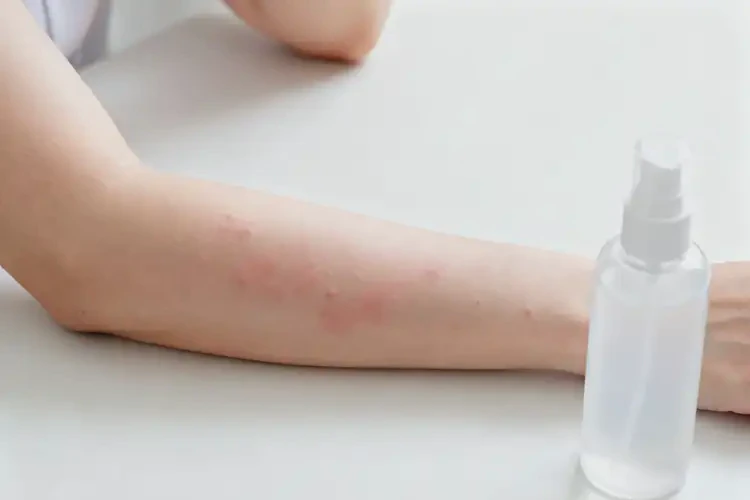 女人身上偶爾起濕疹可以徹底自愈嗎(圖3)