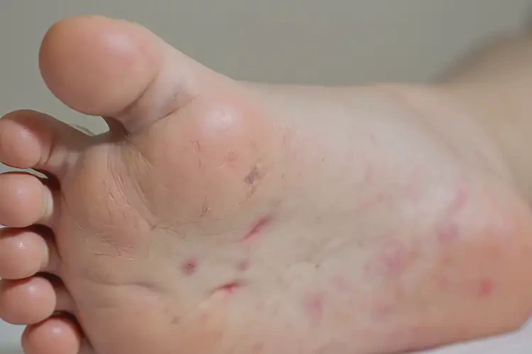 小孩脚上经常起湿疹不管它会自己自愈吗(图4)