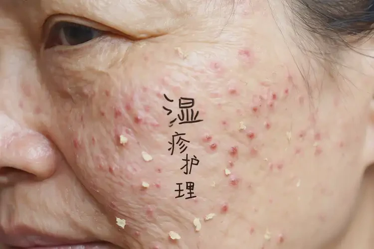 女人面部有濕疹不管它會(huì)自己自愈嗎(圖4)