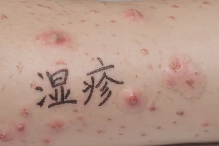 女性手臂容易起濕疹能靠自己自愈嗎(圖4)