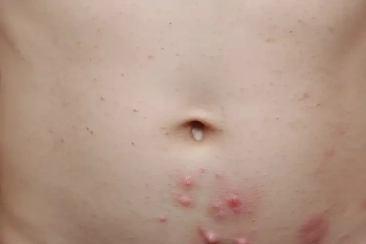孩子肚子容易起濕疹不管它會(huì)自己自愈嗎(圖4)