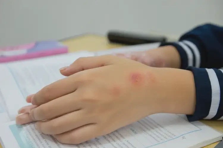 中學(xué)生手上長濕疹可以徹底自愈嗎(圖3)