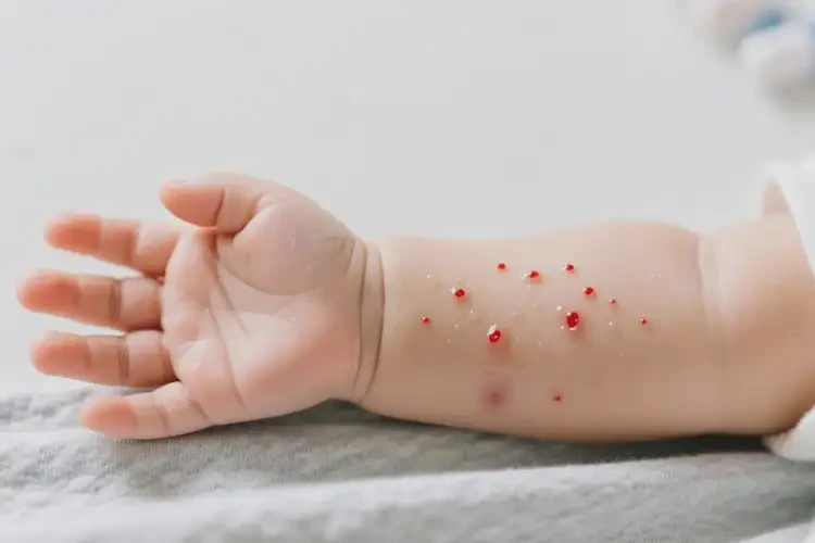 嬰兒手臂上出濕疹能靠自己自愈嗎(圖2)