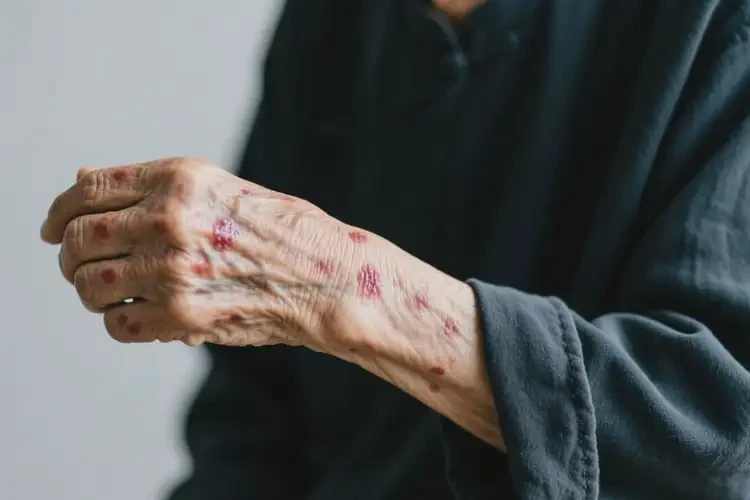 高齡老人身上出現(xiàn)濕疹不管它會(huì)自己痊愈嗎(圖3)