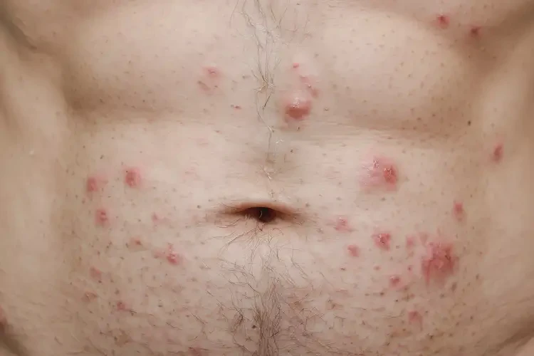 中學生肚子容易起濕疹可不可以徹底自愈(圖4)