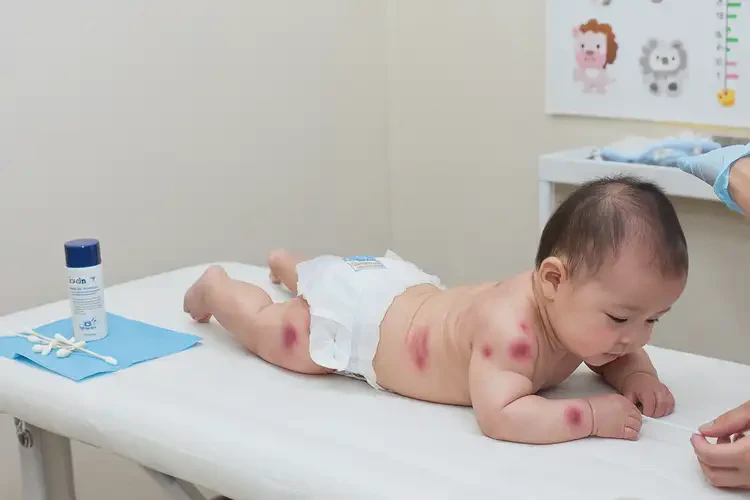 嬰幼兒肛周經(jīng)常長濕疹可以徹底自愈嗎(圖4)