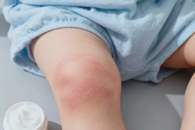 孩子大腿偶爾起濕疹不管它會自己痊愈嗎(圖2)