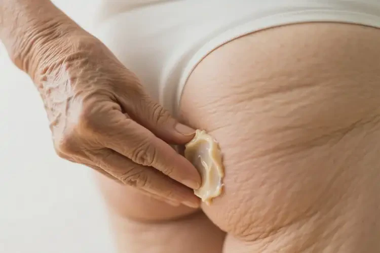 老年人肛周出濕疹可以徹底自愈嗎(圖4)