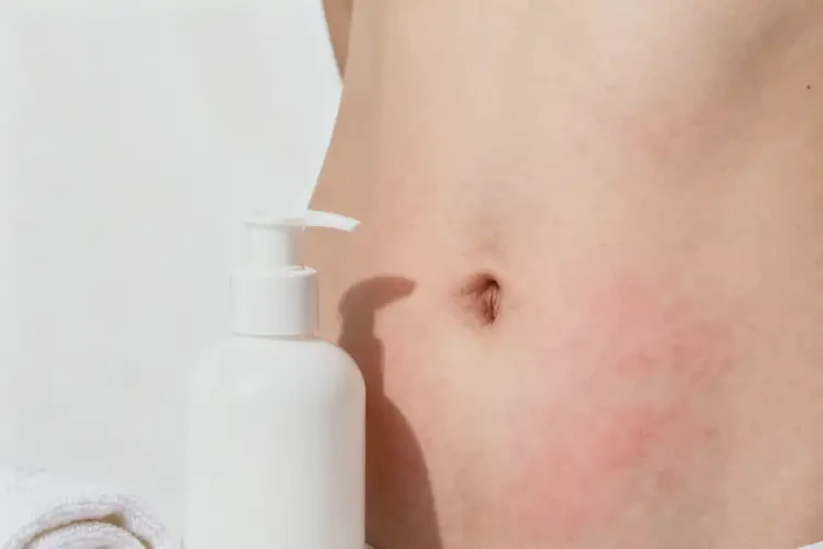 女生肚子容易長濕疹不管它會自己痊愈嗎(圖4)