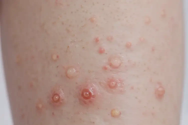 嬰幼兒小腿出濕疹可不可以徹底自愈(圖4)