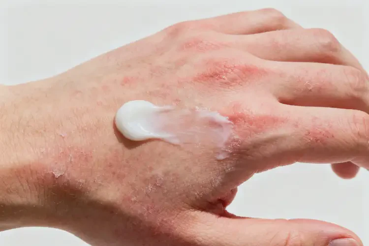 大学生手上偶尔长湿疹能彻底自愈吗(图1)