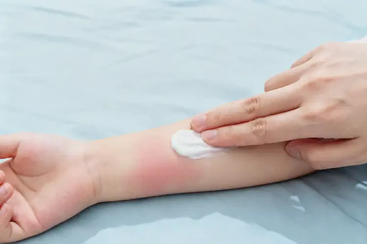 兒童手臂經(jīng)常起濕疹不管它會自己自愈嗎(圖1)