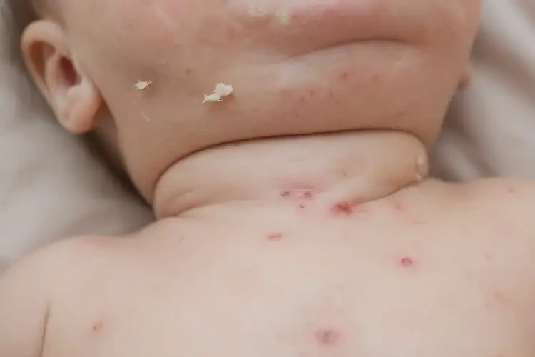 小儿脖子偶尔长湿疹能彻底自愈吗(图3)