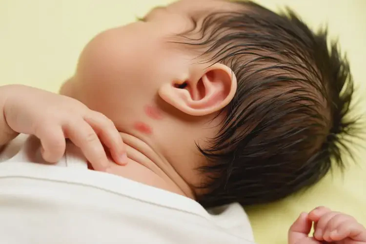 孩子脖子容易長(zhǎng)濕疹不管它會(huì)自己痊愈嗎(圖2)