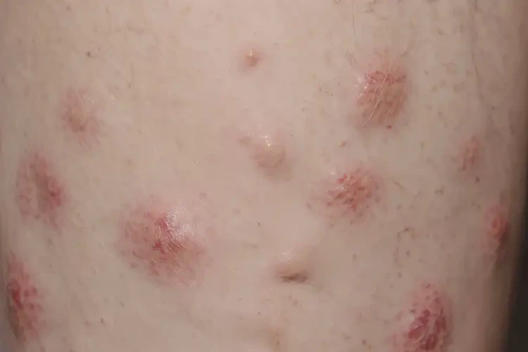 男性大腿容易長濕疹能徹底自愈嗎(圖4)