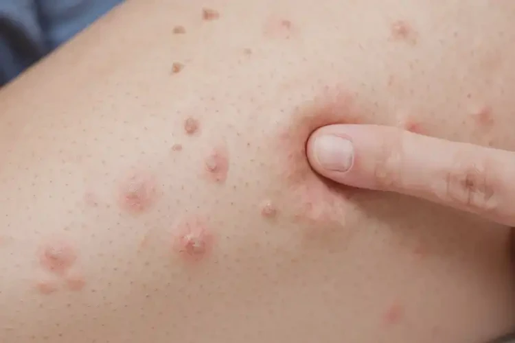 女生大腿出濕疹可不可以徹底自愈(圖4)