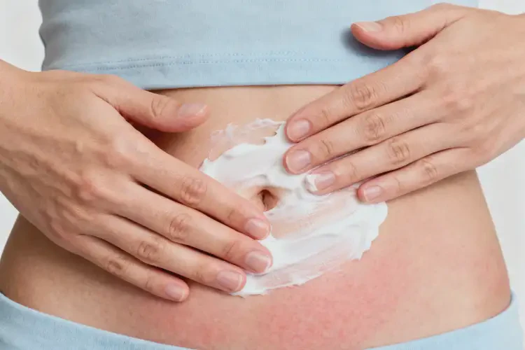 女性肚子有濕疹能徹底自愈嗎(圖2)