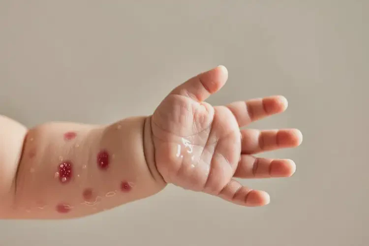 嬰兒手臂上有濕疹不管它會(huì)自己好嗎(圖1)