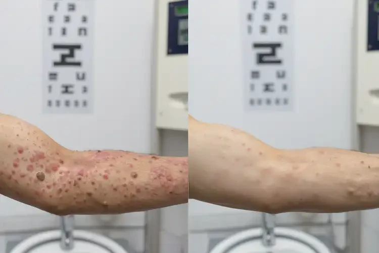 青年人身上經(jīng)常起濕疹可以徹底自愈嗎(圖1)